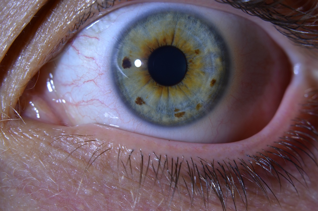 Detailný záber oka, výrazné škvrny na oku